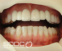 Dental implants, porcelain crowns after