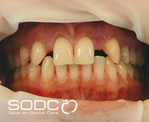 Dental implants, porcelain crowns before