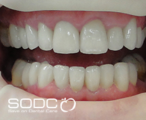 Porcelain bonded crowns after