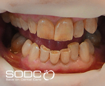 Porcelain bonded crowns before