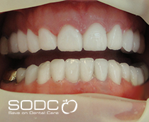 Metal free E-max pressed ceramic veneers after