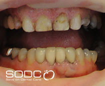 Metal free E-max pressed ceramic veneers before