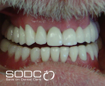 Dental implants before