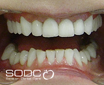 Dental implants, porcelain crowns. after