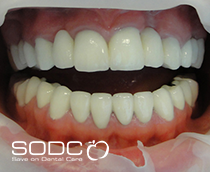 Dental implants, porcelain crowns, veneers before