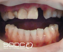 Dental implants, porcelain crowns, veneers after