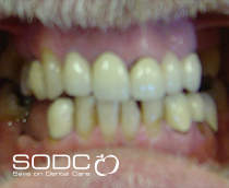 Dental implants after