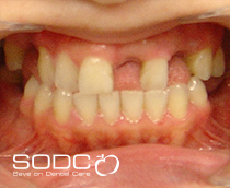 Dental implants after