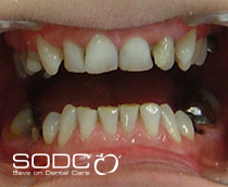 Dental implants, porcelain crowns. before