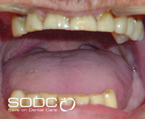 Dental Implants after