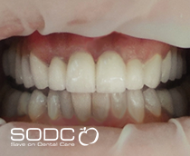 Dental implants, porcelain crown/bridge after