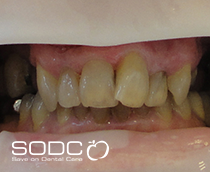 Dental implants, porcelain crown/bridge before