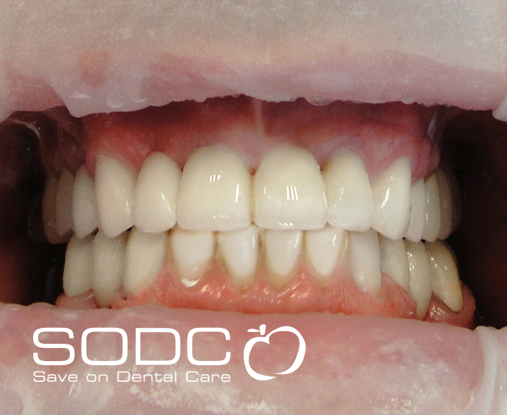 Dental implants, porcelain crowns. before