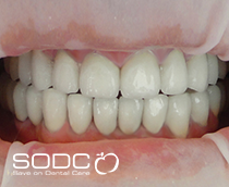 Dental implants, porcelain bridges before