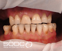 Dental implants, porcelain bridges after