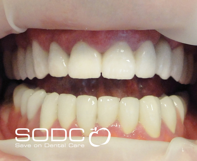 Dental implants, porcelain crowns. after