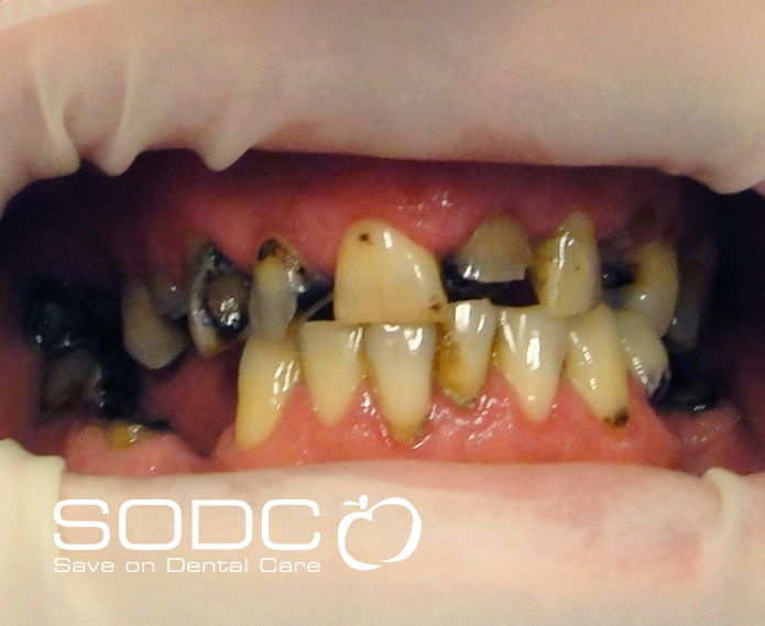 Dental implants, porcelain crowns. before