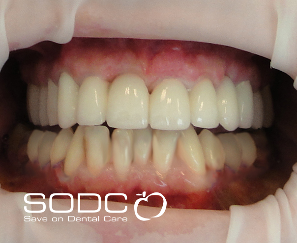 Dental implants, porcelain crowns. before