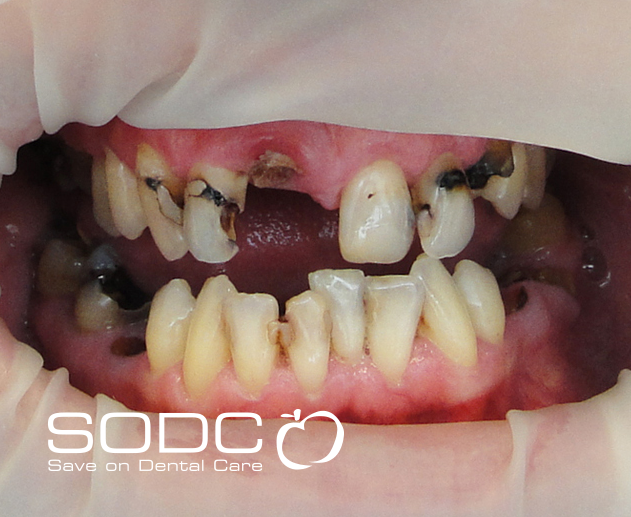 Dental implants, porcelain crowns. after