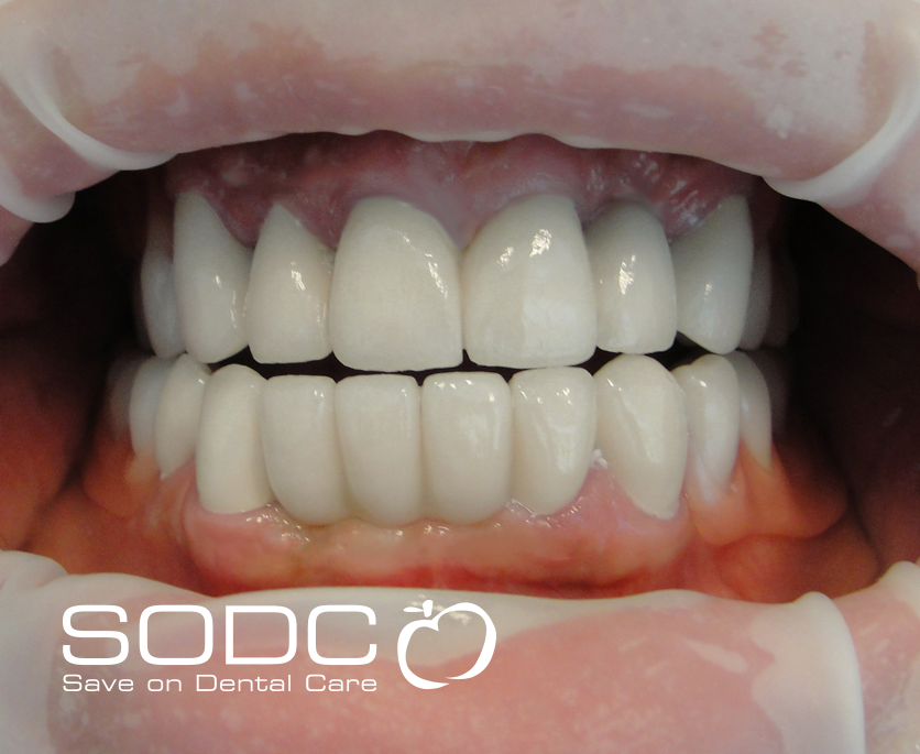 Dental implants, porcelain crown, and bridge before