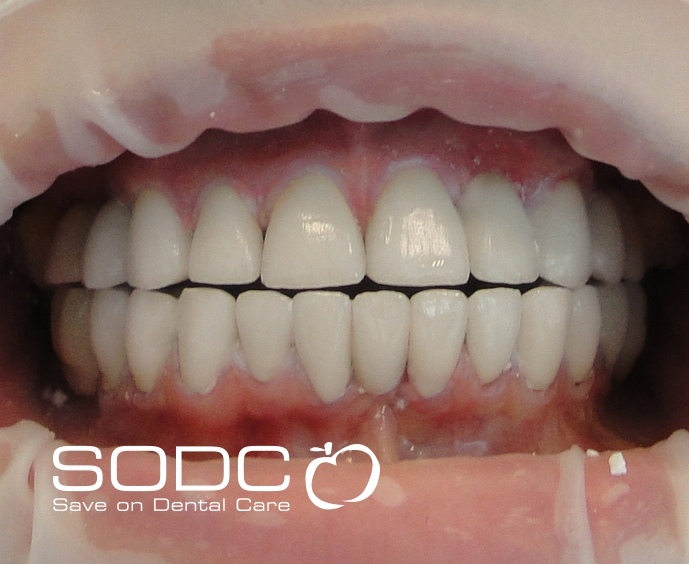 Dental implants, porcelain crowns. after