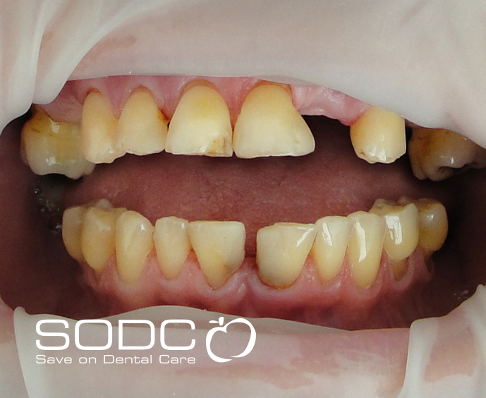 Dental implants, porcelain crowns. before