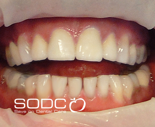 Metal free E-max pressed ceramic crowns and veneers. before