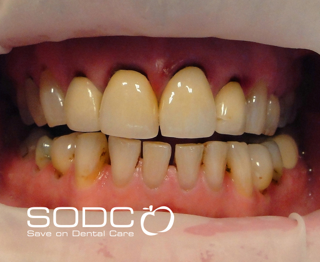 Metal free E-max pressed ceramic crowns and veneers. after