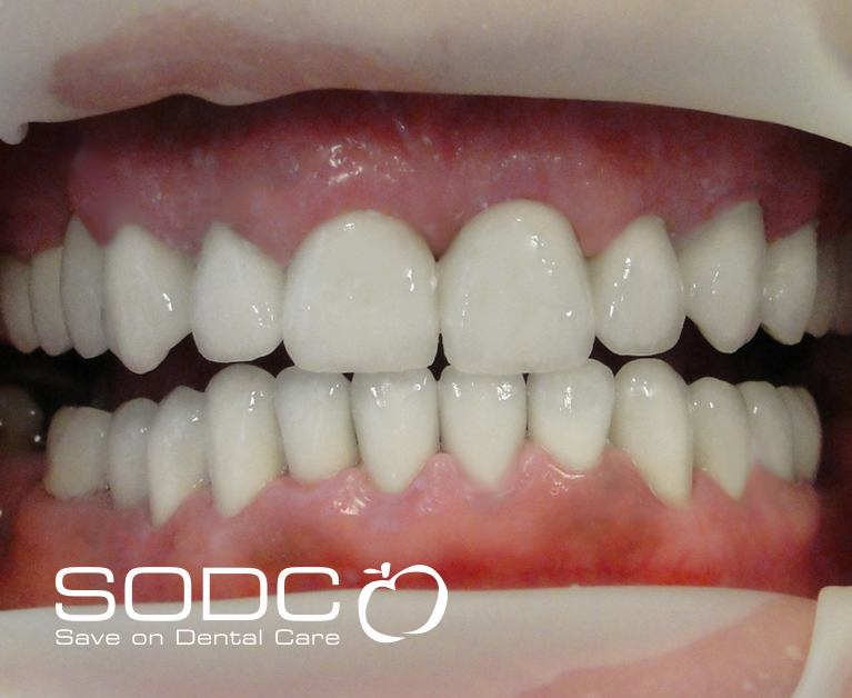 Metal free E-max pressed ceramic crowns and veneers. after