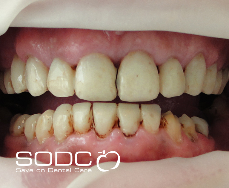 Metal free E-max pressed ceramic crowns and veneers. before