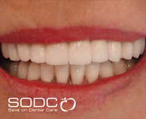  Fixed denture with implants before