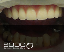 Fixed denture with implants after