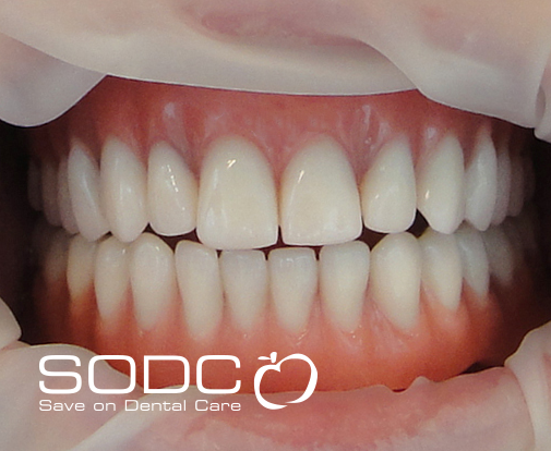 Implant retained denture after
