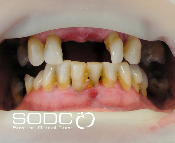 Implant retained denture before