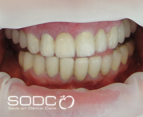 Dental implants, porcelain crowns, veneers after