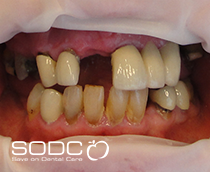 Dental implants, porcelain crowns, veneers before