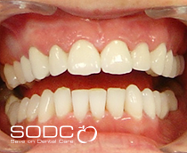 Tooth coloured filling and Opalescence tooth whitening before