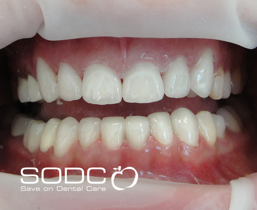 Metal free E-max pressed ceramic crowns and veneers. before