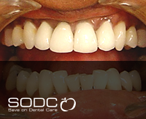 Metal free E-max pressed ceramic crowns and veneers.  after