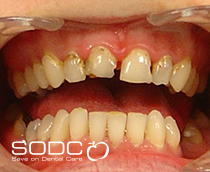 Tooth coloured filling and Opalescence tooth whitening after