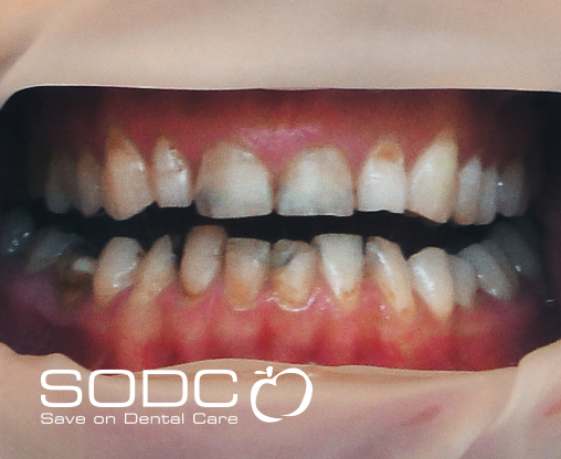 Metal free E-max pressed ceramic crowns and veneers. after