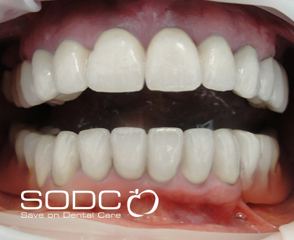 Metal free E-max pressed ceramic crown and bridge, and whitening. after