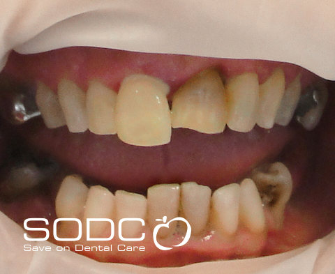 Metal free E-max pressed ceramic crown and bridge, and whitening. before