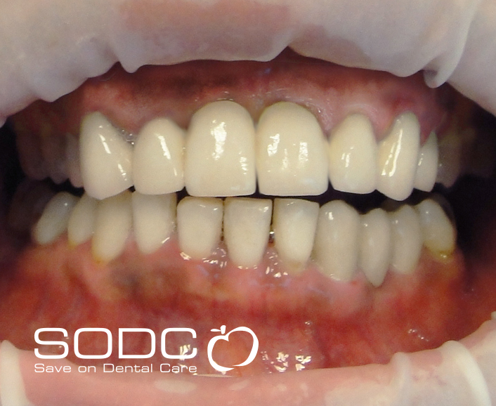 Porcelain bonded crown and whitening. before
