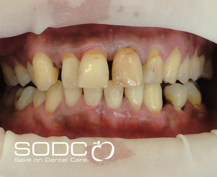 Porcelain bonded crown and whitening. after