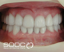 Metal free E-max pressed ceramic crowns and veneers before