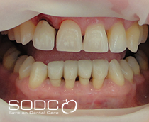 Metal free E-max pressed ceramic crowns and veneers after