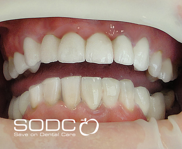Porcelain bridge and tooth whitening. after