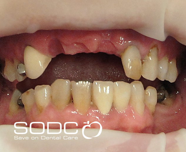 Porcelain bridge and tooth whitening. before