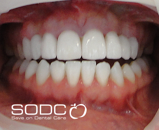 Metal free E-max veneers, dental implant. after